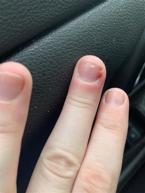 fake nails skin picking reddit